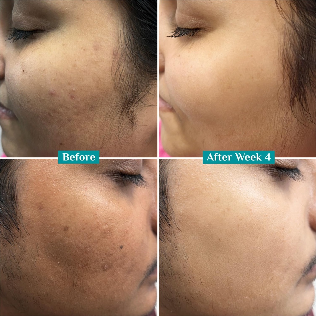 Pilgrim 10% Vitamin C Face Serum - Before & After